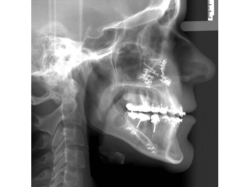 MatrixOrthognathicSystem_17
