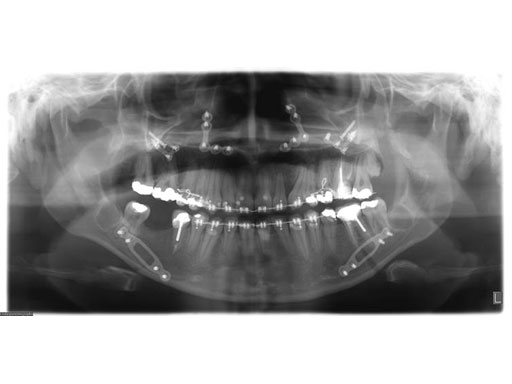 MatrixOrthognathicSystem_18