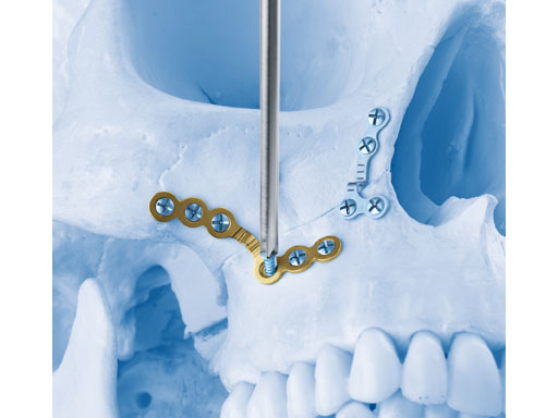 MatrixOrthognathicSystem_9