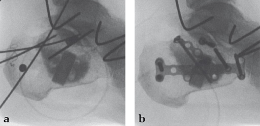 NorianDrillable_10 Norian fig10