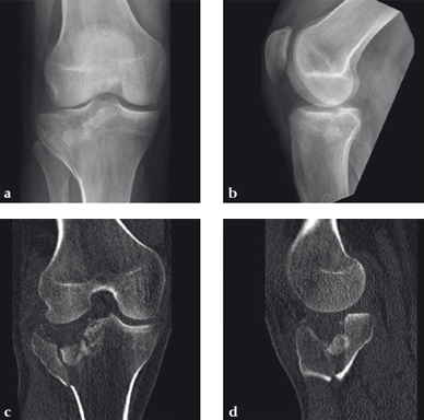 NorianDrillable_11 Norian fig11
