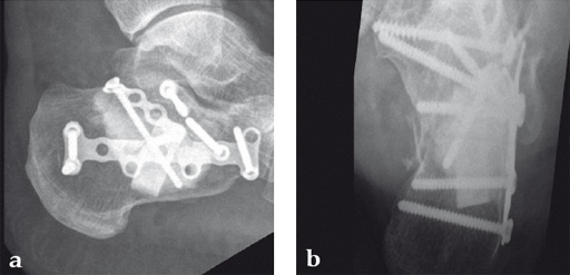 NorianDrillable_7 Norian fig7