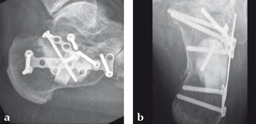 NorianDrillable_8 Norian Fig8