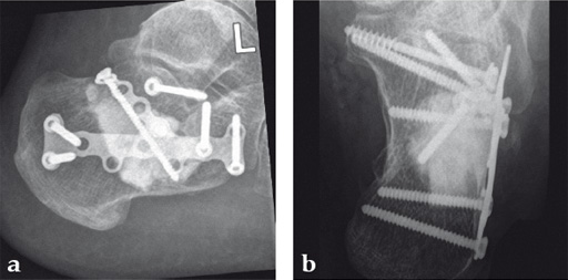 NorianDrillable_9 Norian Fig9