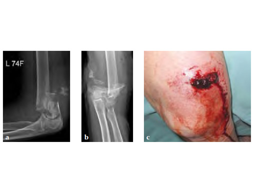 OlecranonOsteotomyNail_3