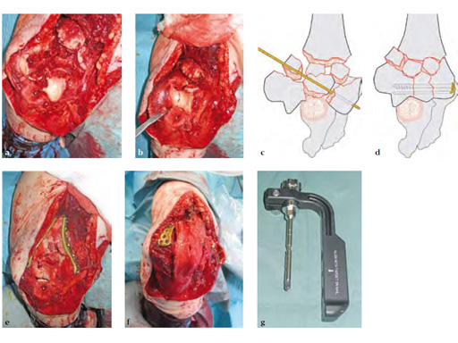 OlecranonOsteotomyNail_4