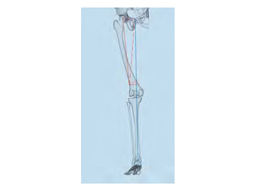 OsteotomyGuidingDevice_2