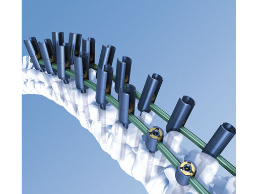 UniversalReductionScrewsTreatmentDeformities_1