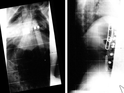 UniversalReductionScrewsTreatmentDeformities_4