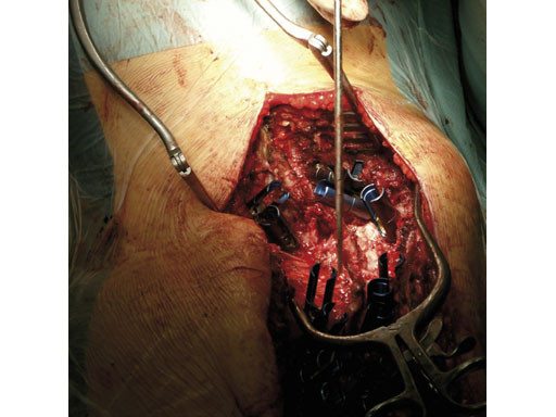 UniversalReductionScrewsTreatmentDeformities_6