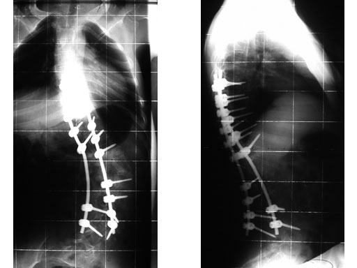 UniversalReductionScrewsTreatmentDeformities_7