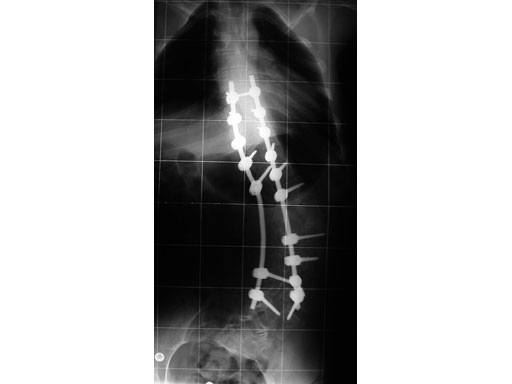 UniversalReductionScrewsTreatmentDeformities_8