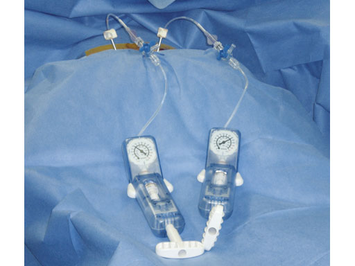 VertebralBodyStent_3