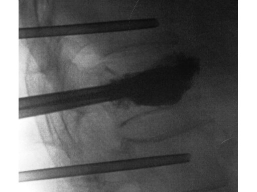 VertebralBodyStent_7