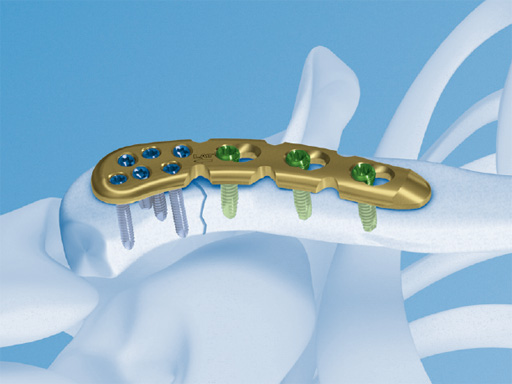 02-fractures-clavicle-01