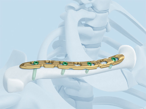 02-fractures-clavicle-04