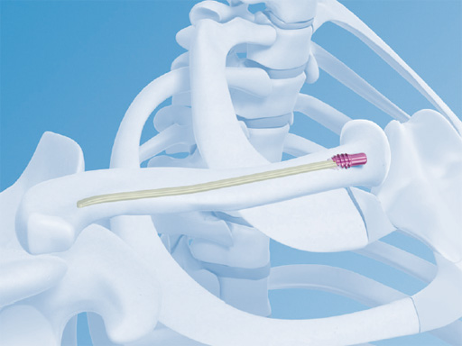 02-fractures-clavicle-07