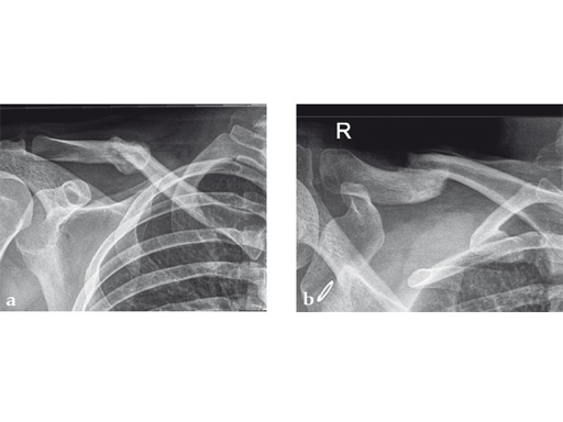 02-fractures-clavicle-08