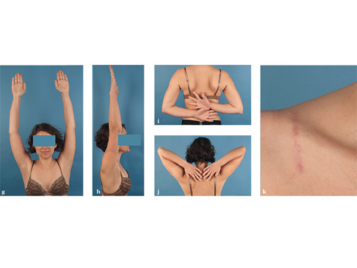 02-fractures-clavicle-11