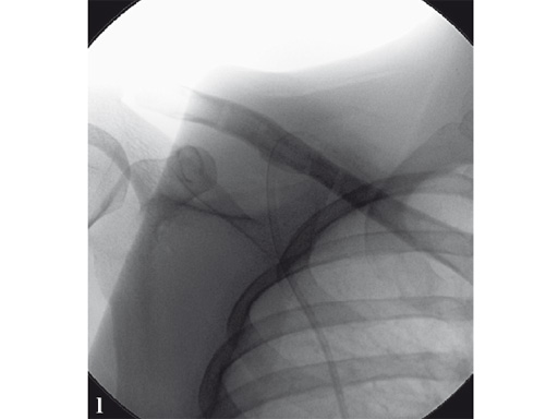 02-fractures-clavicle-12