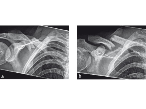 02-fractures-clavicle-13