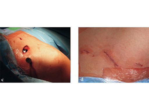 02-fractures-clavicle-14