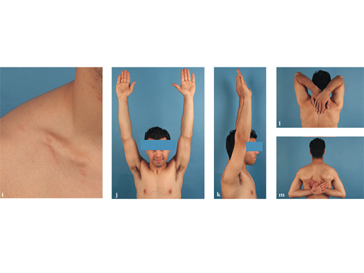 02-fractures-clavicle-17