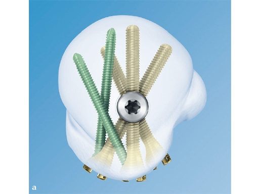 08-MultiLoc-Proximal-Humeral-Nail-02