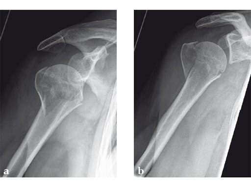 08-MultiLoc-Proximal-Humeral-Nail-04