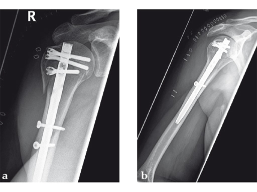 08-MultiLoc-Proximal-Humeral-Nail-05