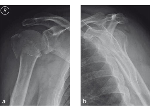 08-MultiLoc-Proximal-Humeral-Nail-06