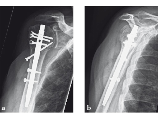 08-MultiLoc-Proximal-Humeral-Nail-07