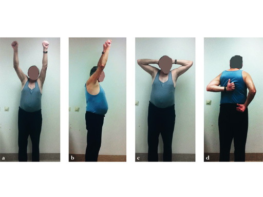 08-MultiLoc-Proximal-Humeral-Nail-08