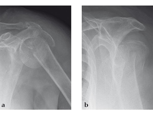 08-MultiLoc-Proximal-Humeral-Nail-09
