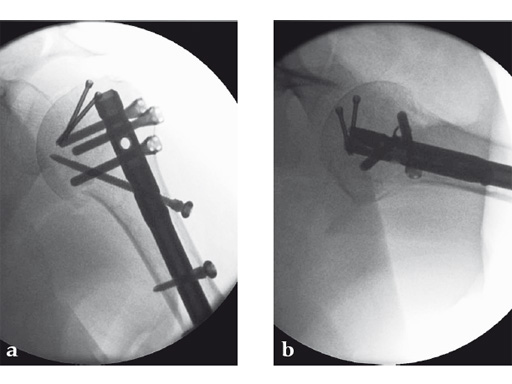 08-MultiLoc-Proximal-Humeral-Nail-10