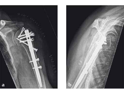 08-MultiLoc-Proximal-Humeral-Nail-11