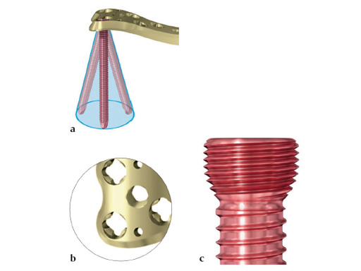 14-4-5-VA-LCP-Curved-Condylar-02