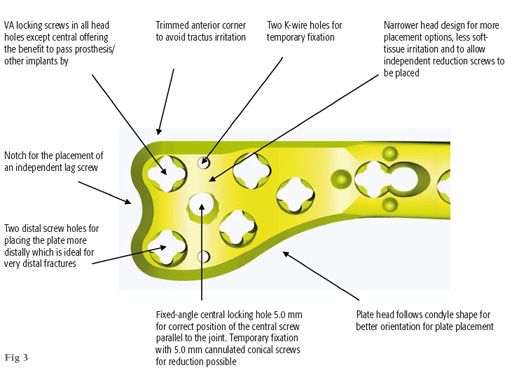 14-4-5-VA-LCP-Curved-Condylar-03