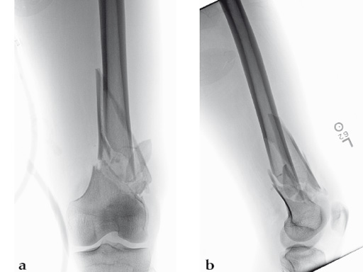 14-4-5-VA-LCP-Curved-Condylar-04