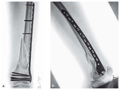 14-4-5-VA-LCP-Curved-Condylar-05 Fig 2a-b Six-week follow-up: AP (a) and lateral (b) x-rays.
