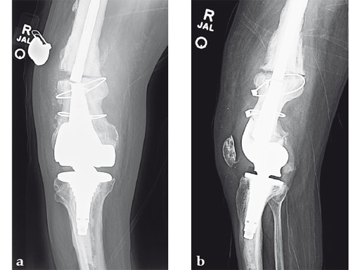14-4-5-VA-LCP-Curved-Condylar-06