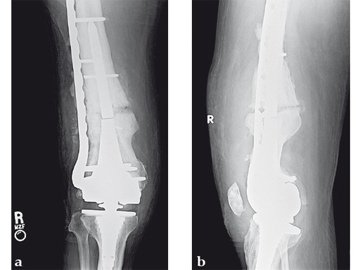 14-4-5-VA-LCP-Curved-Condylar-07