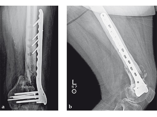 14-4-5-VA-LCP-Curved-Condylar-08