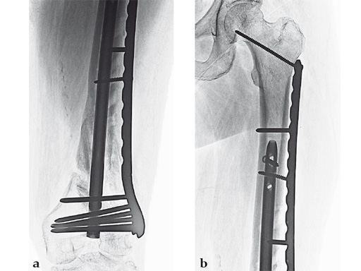 14-4-5-VA-LCP-Curved-Condylar-09