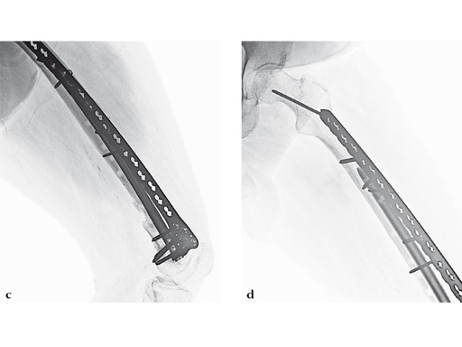 14-4-5-VA-LCP-Curved-Condylar-10