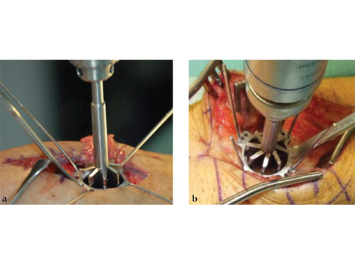 2-4-VA-Locking-Intercarpal-Fusion-System-11