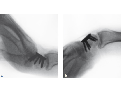 2-4-VA-Locking-Intercarpal-Fusion-System-18