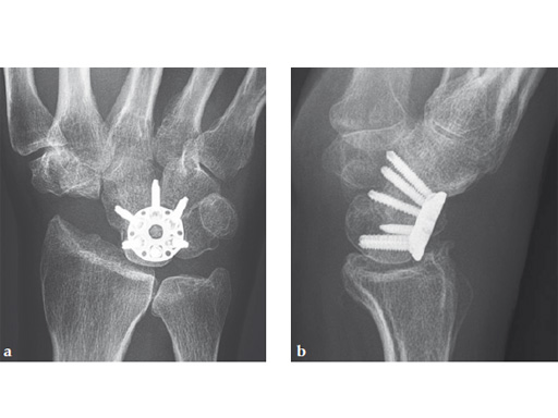 2-4-VA-Locking-Intercarpal-Fusion-System-19