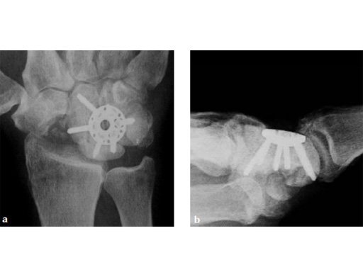 2-4-VA-Locking-Intercarpal-Fusion-System-21
