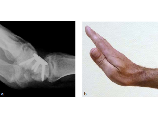 2-4-VA-Locking-Intercarpal-Fusion-System-22